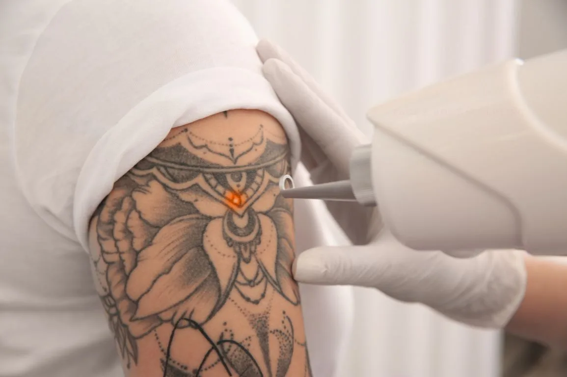 Tattoo Removal at Sculpt by Sumera